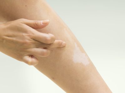 足の白い斑点は放置しても大丈夫？ かゆみ・むくみ・子ども・妊婦別に解説